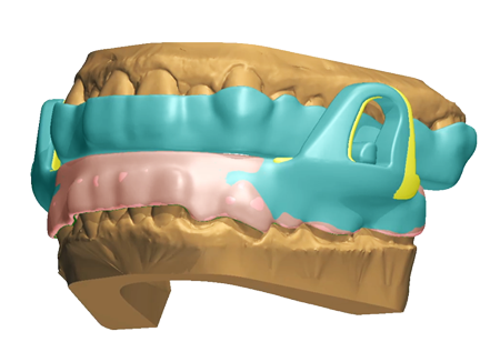 Diseño 3D de OrthoApnea NOA sobre el modelo dental